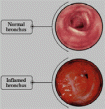 the images of a normal bronchus and an inflamed one