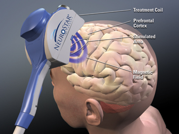 How TMS Therapy Works