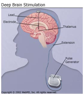 How DBS is implanted