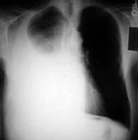 Large pleural effusion