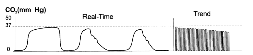 Use of Capnography During Resuscitation of Patients in CCU - 23120 ...