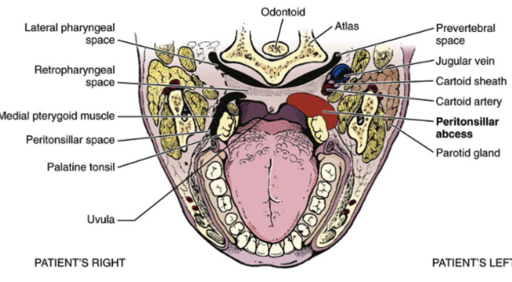 Peritonsillar Abscess
