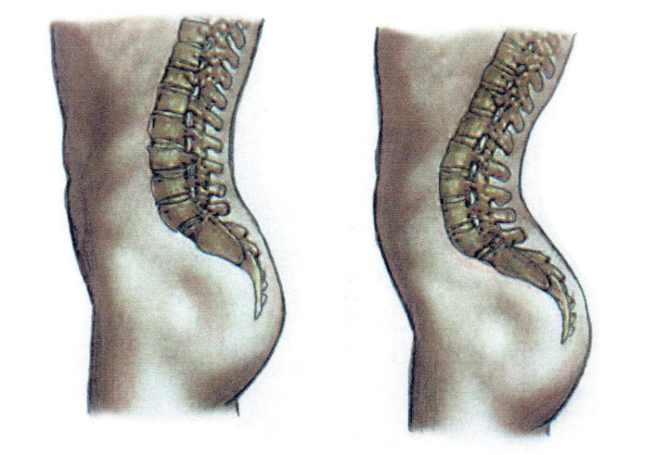 Lordosis: Damaged Structures and Possible Causes